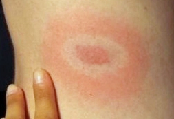 Classic 'bulls eye' rash following an infected tick bite, however such rashes do not always occur. Image copyright Lyme Disease Action